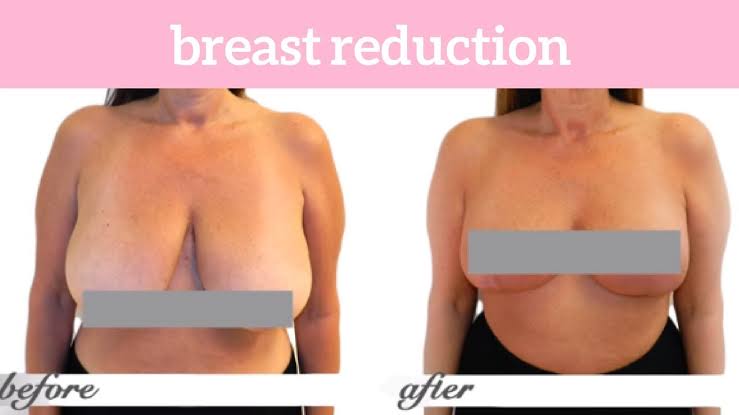 breast reduction before and after
